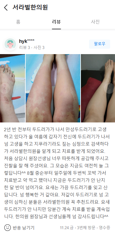 만성두드러기 치료후기