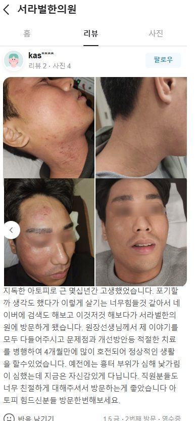 아토피 후기