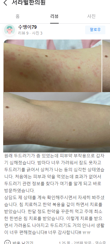 두드러기 치료후기