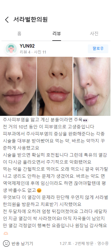 주사피부염 후기