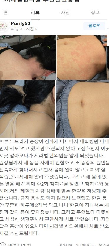 두드러기 치료 후기