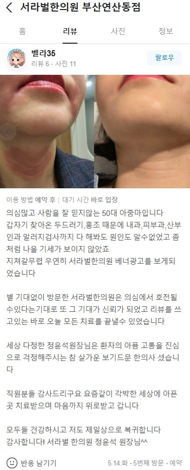 두드러기, 홍조 치료 후기