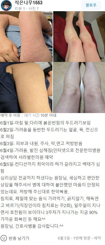 두드러기치료 후기