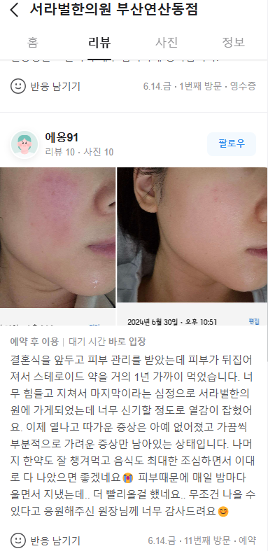 피부염 치료 후기
