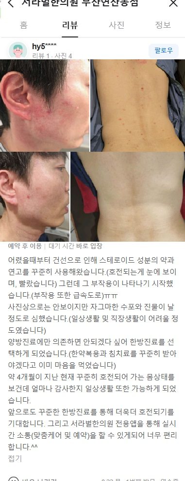건선 치료 후기