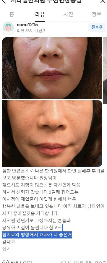 안면홍조 치료 후기