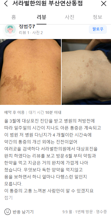 대상포진 치료 후기