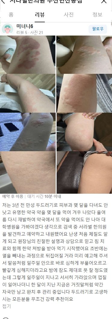 만성두드러기 치료후기