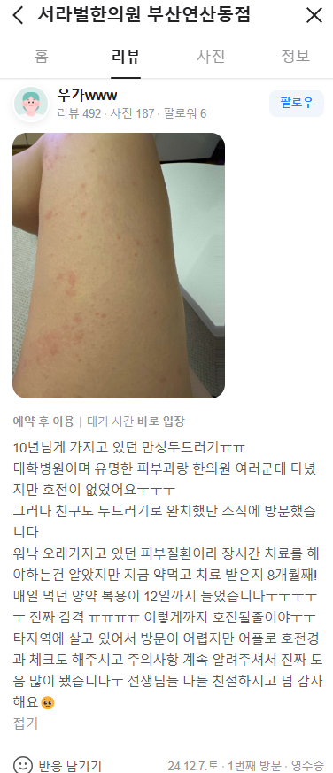 만성두드러기 치료후기