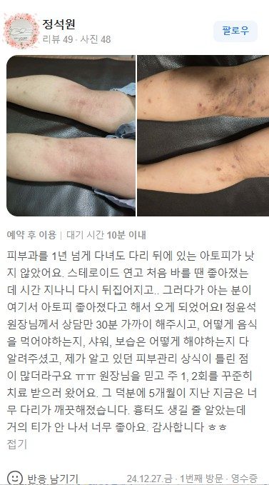 아토피 치료