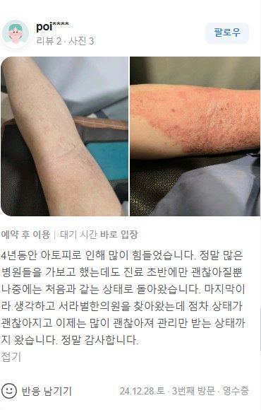 아토피 치료후기
