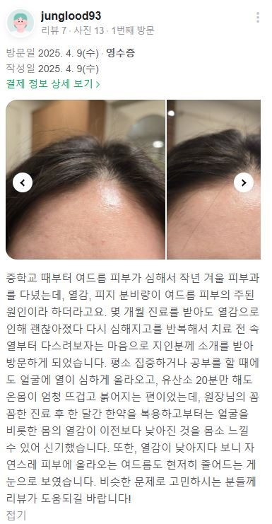 피부질환 후기