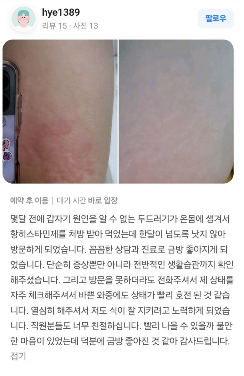 두드러기 치료후기