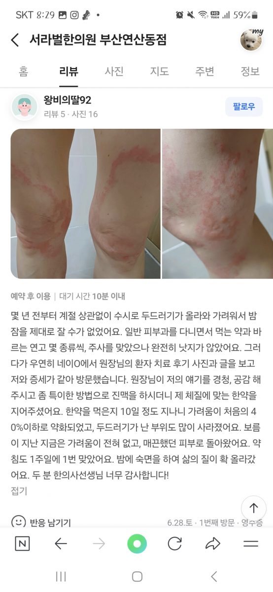 두드러기 치료후기