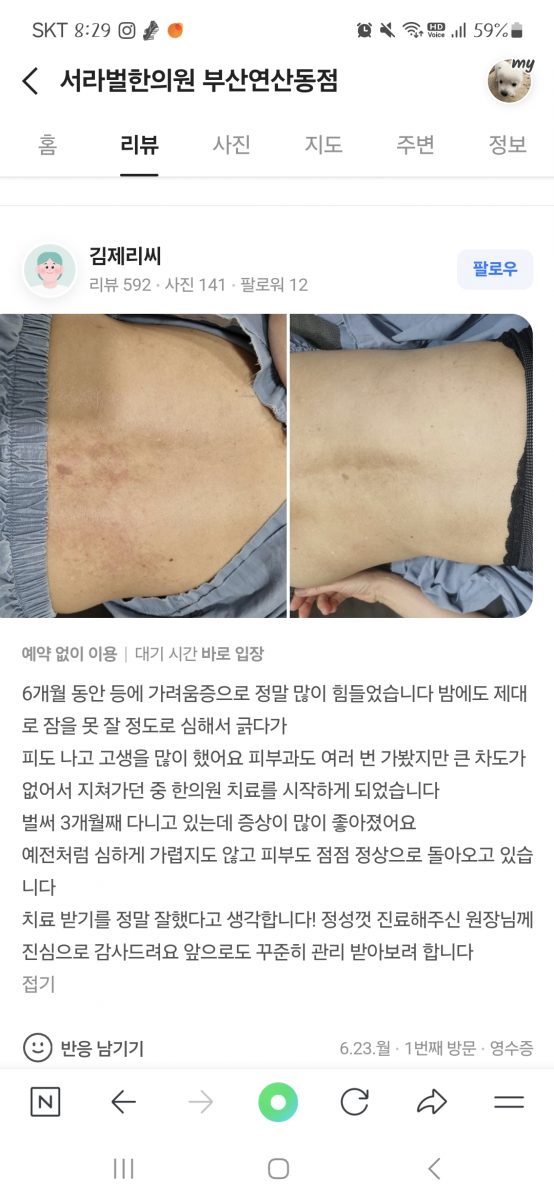 가려움증 치료후기