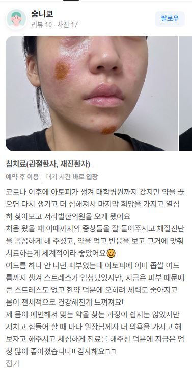 아토피 치료후기