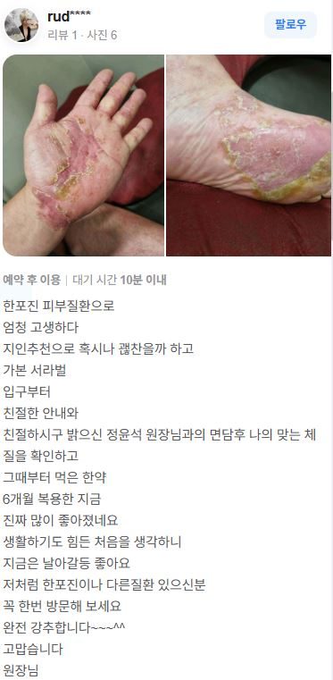 한포진 치료후기