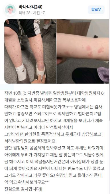 자반증 치료후기