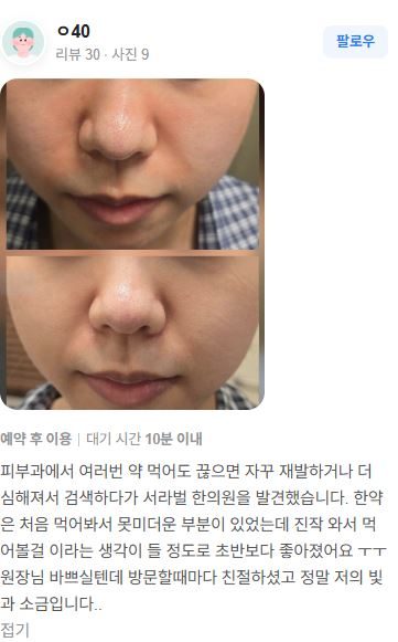 피부염 치료후기