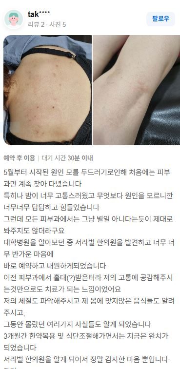두드러기 치료후기