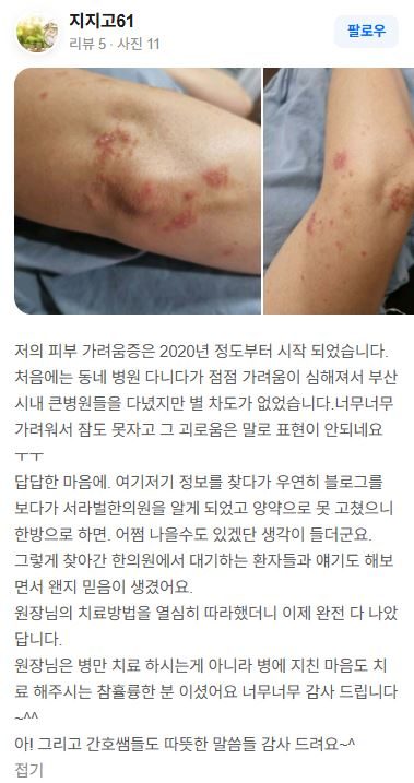 피부가려움증 치료후기