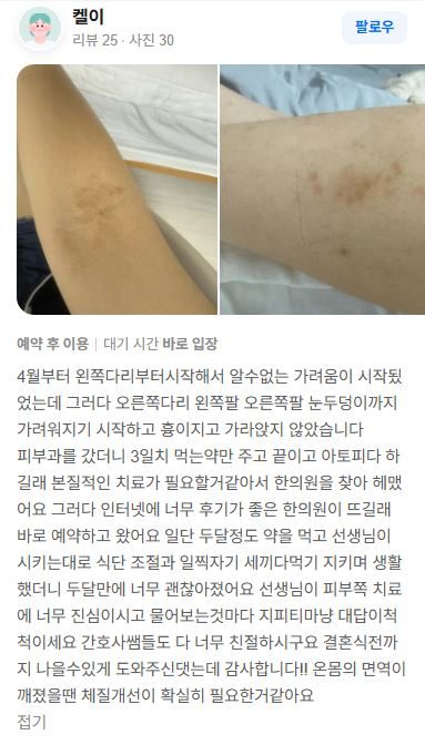 아토피 치료후기