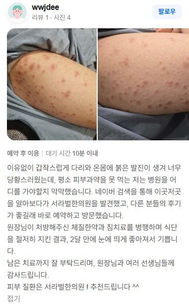 두드러기 치료후기