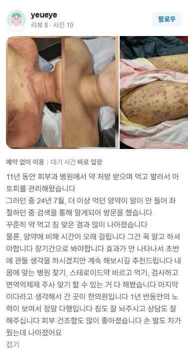 아토피 치료후기