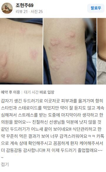 두드러기 치료후기