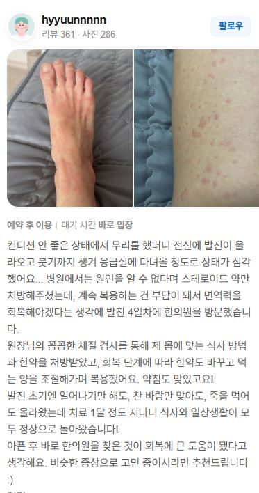 피부발진 치료후기