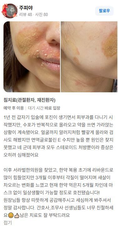 알러지 치료후기