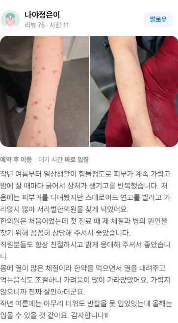 두드러기 치료후기