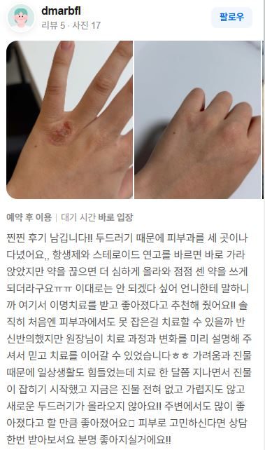 두드러기, 습진 치료후기
