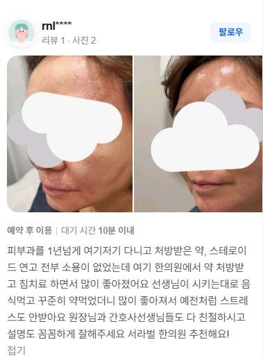 접촉성피부염 치료후기