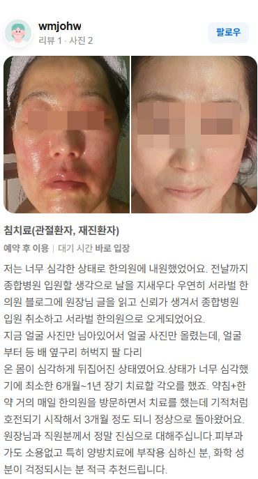 전신피부질환 치료후기