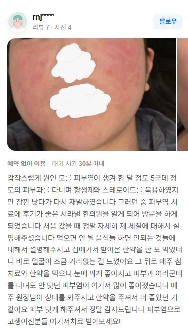 피부염 치료후기