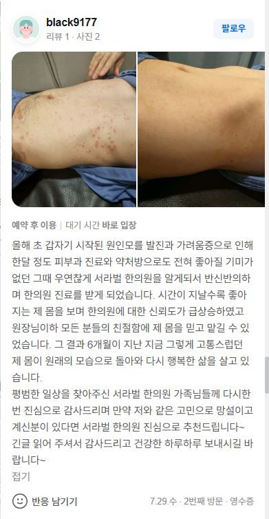 가려움증 치료후기