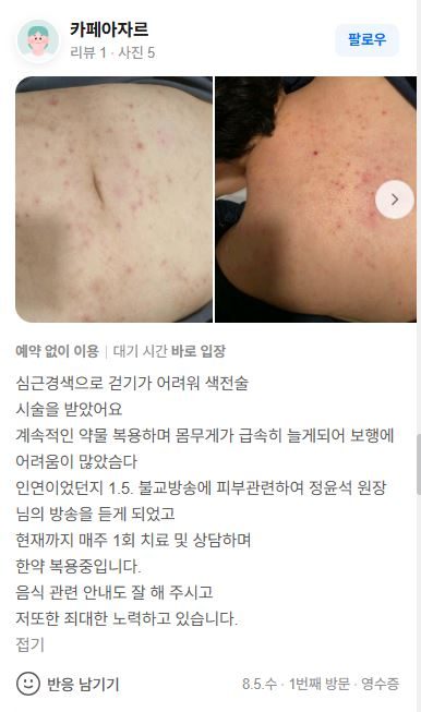 피부염 치료후기