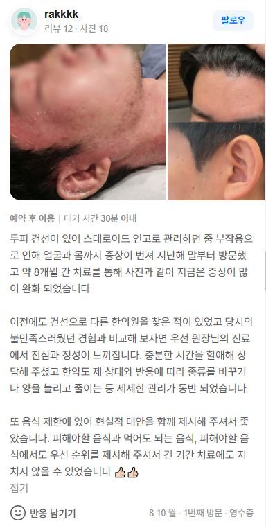 건선 치료후기