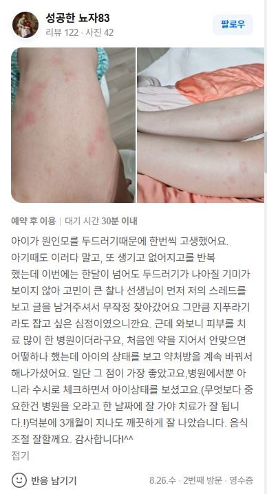 두드러기 치료후기