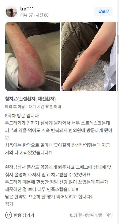 두드러기 치료후기
