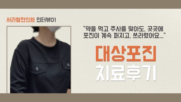 대상포진 치료후기